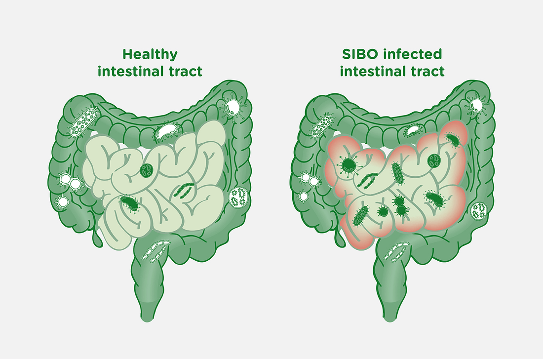 SIBO: How Small Intestinal Bacterial Overgrowth Impacts Your Microbiome & Your Overall Health